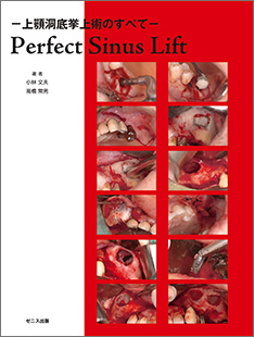 Perfect Sinus Lift－上顎洞底挙上術のすべて－