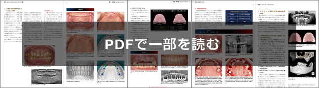 多数歯欠損・無歯顎症例へのインプラント治療