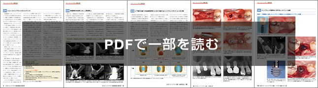 ワイド・ショートインプラントの基礎と臨床 第5世代のインプラント治療