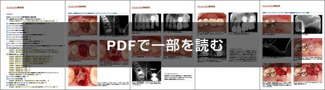 ワイド・ショートインプラントの基礎と臨床 完全版 第5世代のインプラント治療